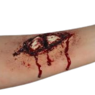 Open Compound Fracture: Casualty Simulation